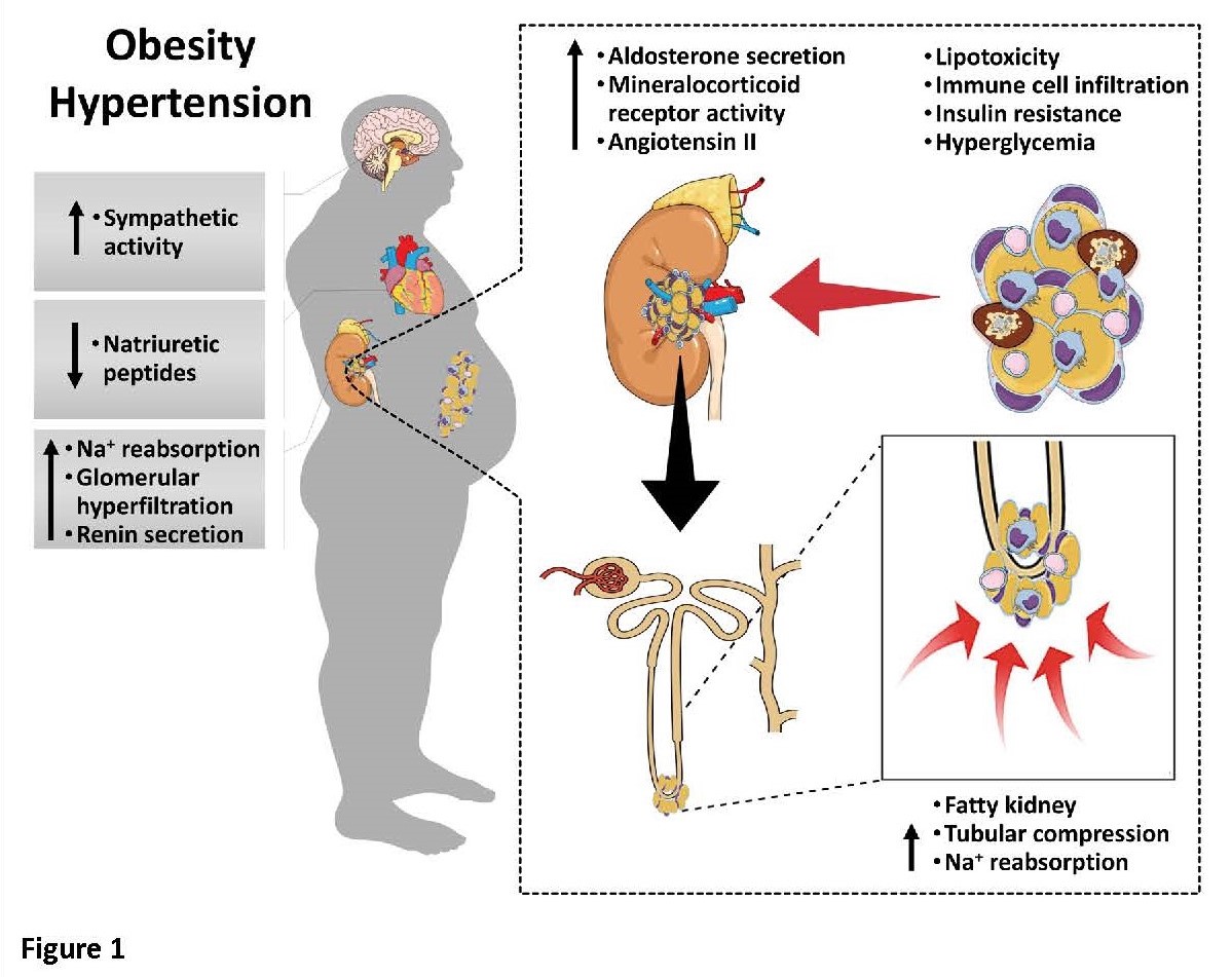 Obesity and hypertension deals
